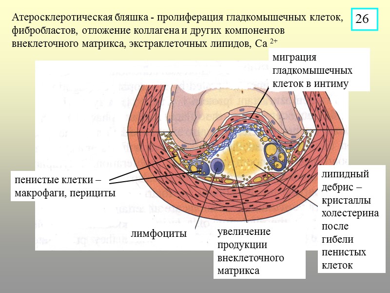 Атеросклеротическая бляшка - пролиферация гладкомышечных клеток, фибробластов, отложение коллагена и других компонентов внеклеточного матрикса,